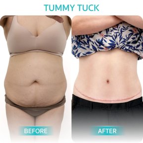 before-after photo body-lift