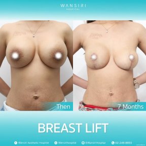 before-after photo abdominoplasty