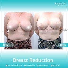before-after photo abdominoplasty