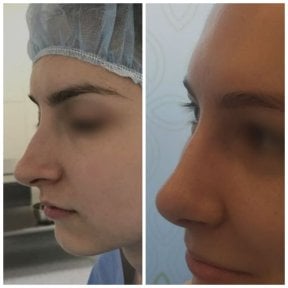 before-after photo rhinoplasty-nose-job