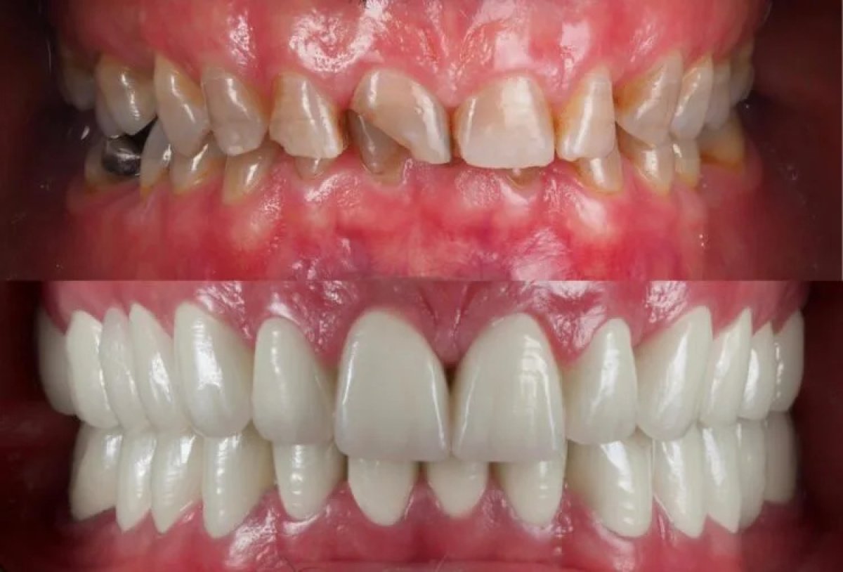 نتائج قبل وبعد تجميل الابتسامة – قشور الأسنان لتحسين مظهر الأسنان
