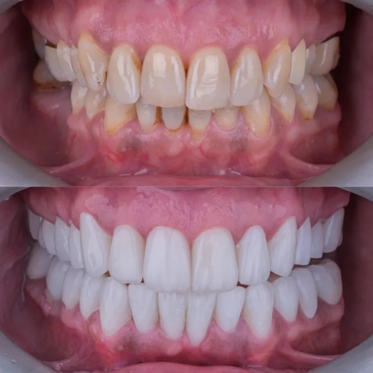 Resultados antes y después del blanqueamiento dental láser – sonrisa visiblemente más blanca