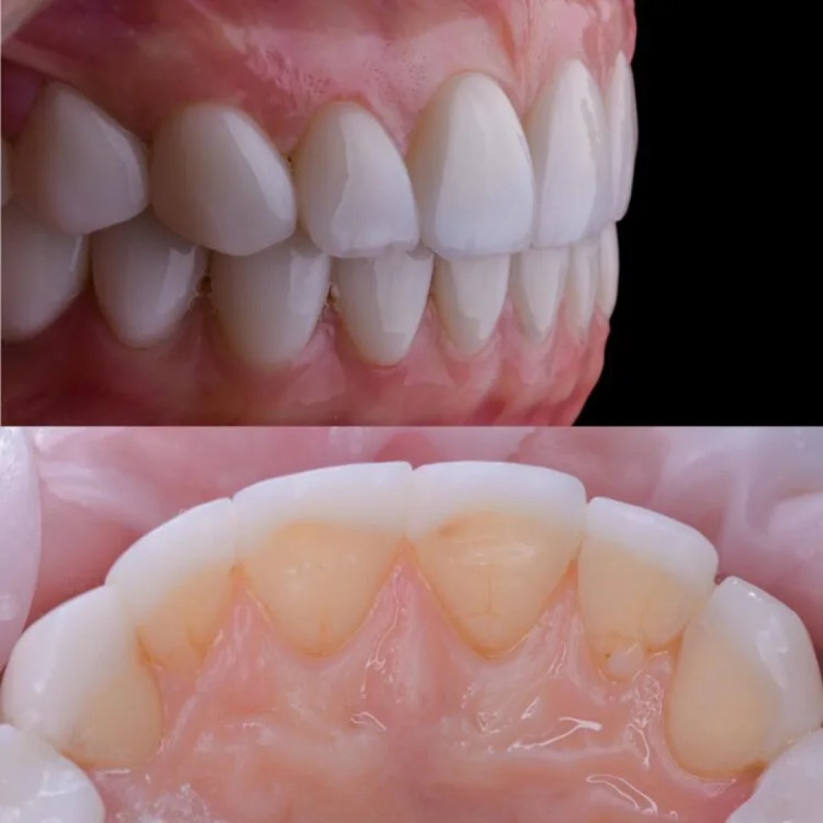 Resultados de limpieza dental (raspado) – mejor higiene y eliminación de sarro