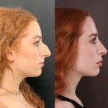 نتيجة عملية تجميل الأنف قبل وبعد في Dream International Clinic، تحسين شكل الأنف