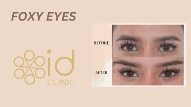 before-after photo facial-fat-transfer