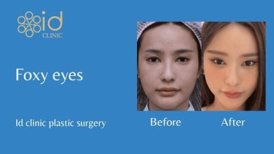 before-after photo facial-fat-transfer