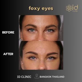 before-after photo facial-fat-transfer