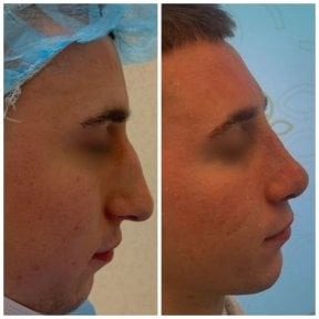 before-after photo rhinoplasty-nose-job