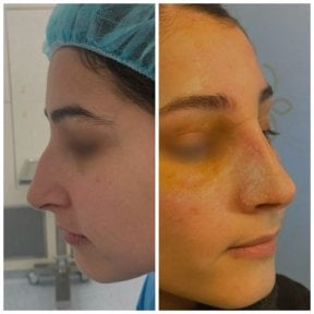 before-after photo rhinoplasty-nose-job