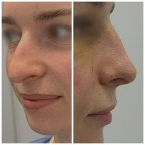 before-after photo rhinoplasty-nose-job