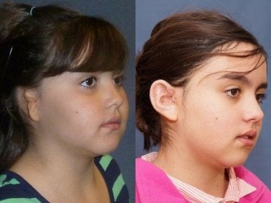 Before and after ear reconstruction results at Memorial Ankara Hospital for congenital ear deformity