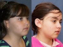 Before and after ear reconstruction results at Memorial Ankara Hospital for congenital ear deformity