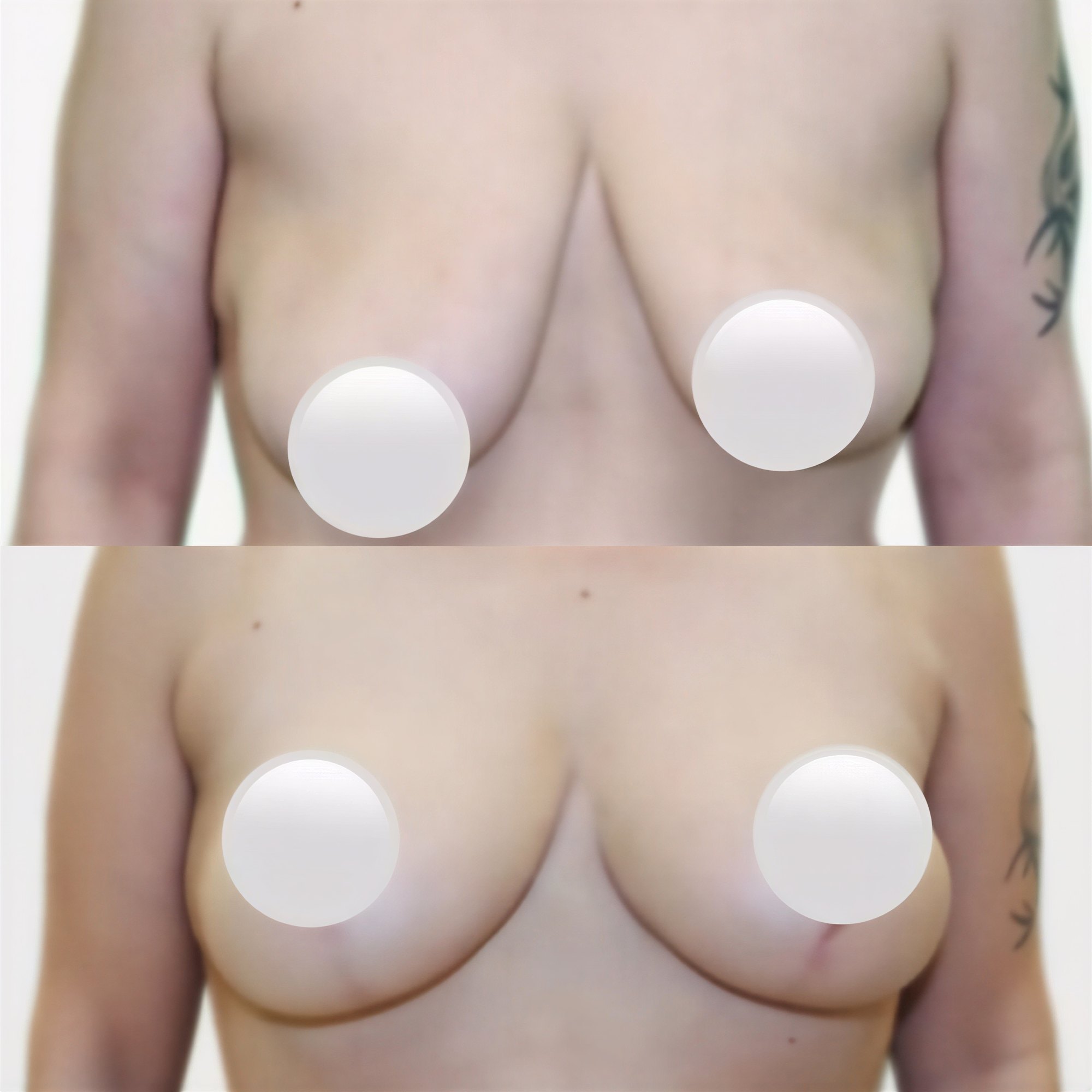 Resultados de lifting de senos antes y después en Premier Clinic, mejor forma y contorno