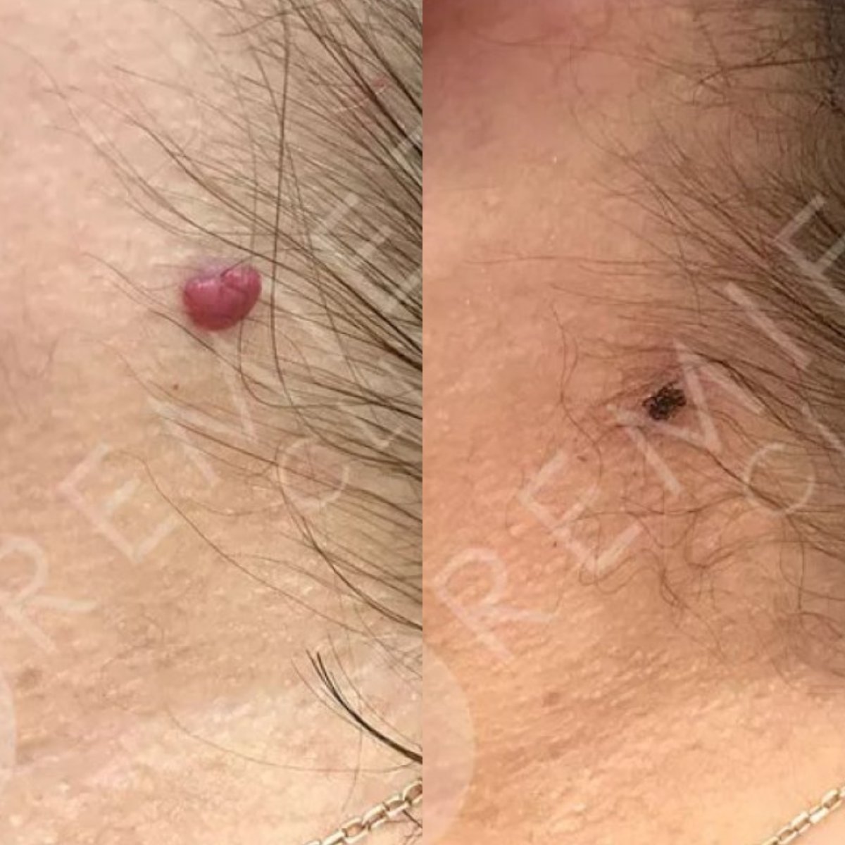 Resultados antes y después de la eliminación de lunares con láser en Premier Clinic