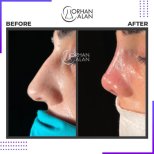 نتائج تجميل الأنف قبل وبعد في عيادة Dr.Orhan ALAN، تحسين شكل الأنف