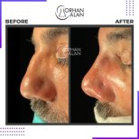نتائج تجميل الأنف قبل وبعد في عيادة Dr.Orhan ALAN، تحسين شكل الأنف وتناسقه