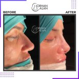 نتائج تجميل الأنف قبل وبعد في عيادة Dr.Orhan ALAN، تحسين شكل الأنف الجانبي