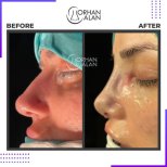 نتائج تجميل الأنف قبل وبعد في عيادة Dr.Orhan ALAN، تحسين شكل الأنف