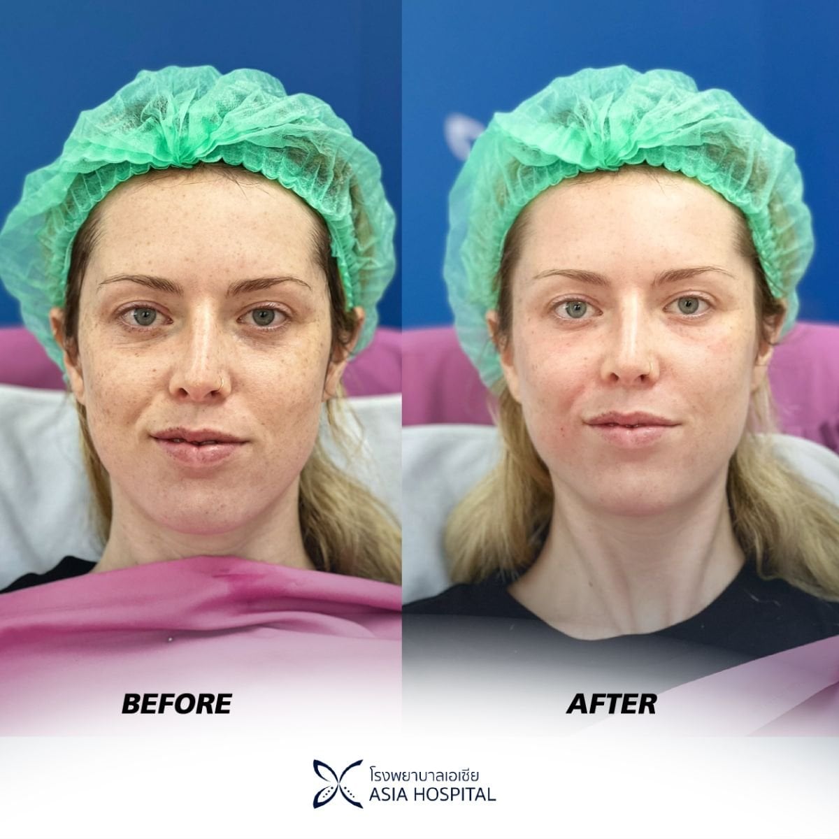نتائج قبل وبعد حقن الفيلر في Asia Cosmetic Hospital، تحسين ملامح الوجه