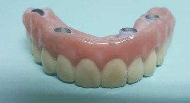 All-on-4 dental implants prosthesis at SoftDentalCare Clinic, fixed teeth restoration result