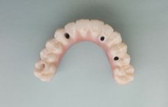 All-on-4 dental implants prosthesis at SoftDentalCare Clinic, upper jaw restoration result