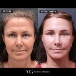 Facelift before and after results at VG Plastic Surgery, visible facial rejuvenation after 2 weeks