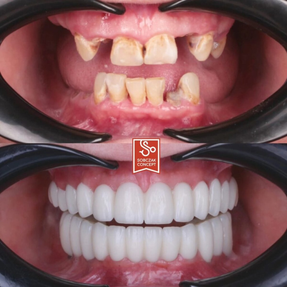 Antes y después de carillas dentales en DR SOBCZAK KLINIKI – transformación de sonrisa