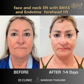 Before and after facelift and neck lift with SMAS at ID Clinic Bangkok, visible rejuvenation result