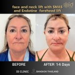 Before and after facelift and neck lift with SMAS at ID Clinic Bangkok, visible rejuvenation result