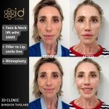 Before and after facelift, neck lift, rhinoplasty, and lip filler results at ID Clinic Bangkok