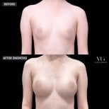 نتائج حقن الدهون للصدر قبل وبعد في VG Plastic Surgery، زيادة حجم طبيعية