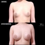 نتائج حقن الدهون للصدر قبل وبعد في VG Plastic Surgery، تكبير طبيعي للحجم