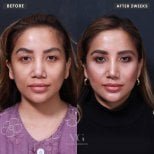 Before and after lip lift results at VG Plastic Surgery, enhanced lip contour and symmetry