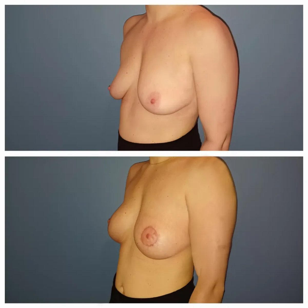 Resultados antes y después de mastopexia con implantes redondos en clínica Dr. Struk París