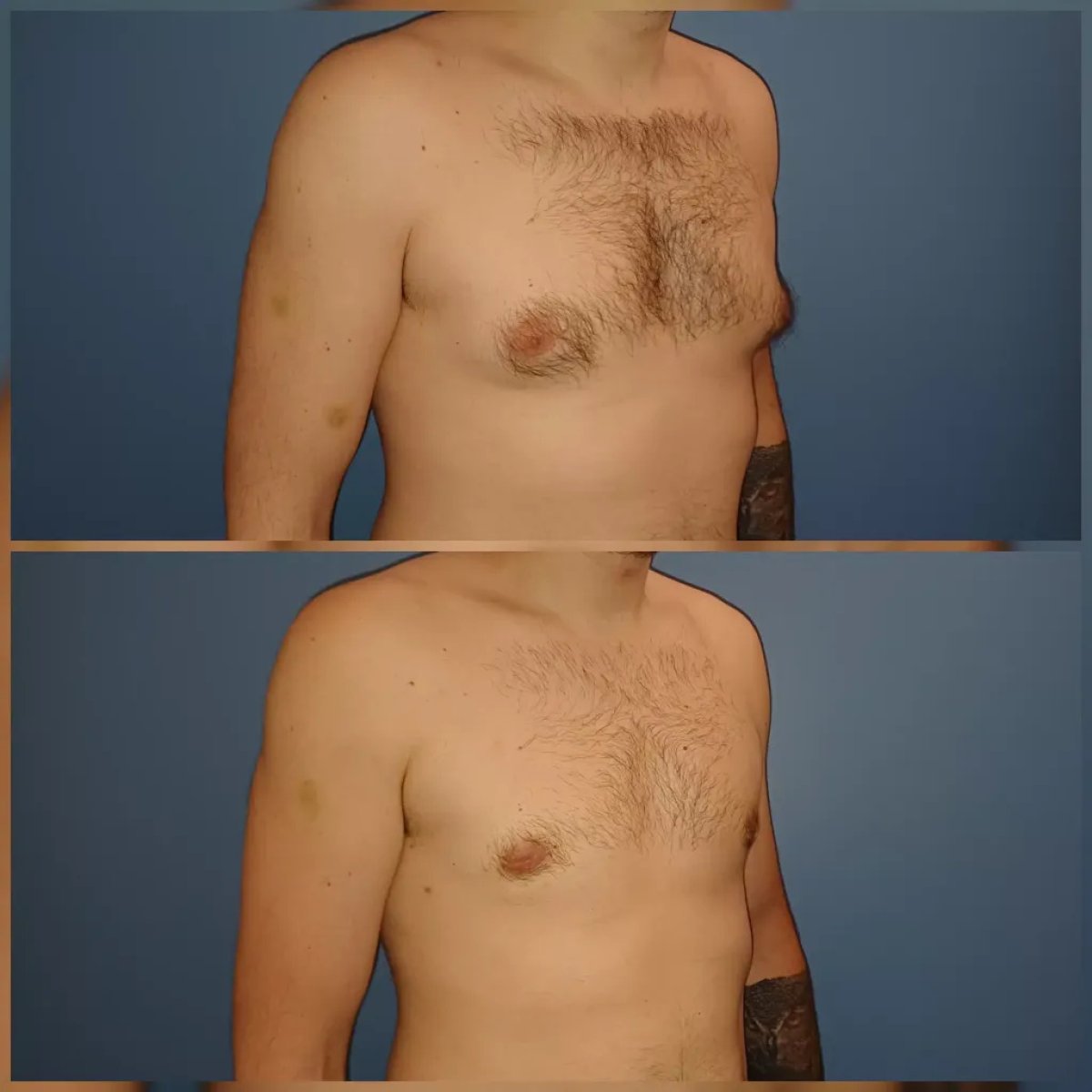Antes y después de liposucción por ginecomastia en Docteur Samuel Struk, resultado de tórax