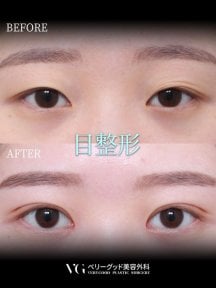 Vorher-nachher-Ergebnis der Blepharoplastik bei VG Plastic Surgery, Lidkorrektur