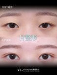 Vorher-nachher-Ergebnis der Blepharoplastik bei VG Plastic Surgery, Lidkorrektur