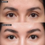 Blepharoplastik Vorher-Nachher-Ergebnis bei VG Plastic Surgery, Lidkorrektur nach 1 Woche