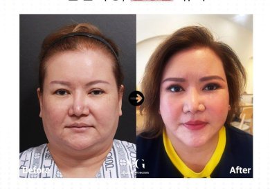 Before and after brow lift results at VG Plastic Surgery, visible eyebrow and eyelid enhancement