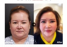 Before and after brow lift results at VG Plastic Surgery, visible eyebrow and eyelid enhancement