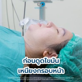 Before Vaser liposuction at Cosmacare Clinic, visible chin and jawline fat accumulation