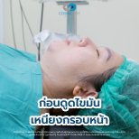 Before Vaser liposuction at Cosmacare Clinic, visible chin and jawline fat accumulation