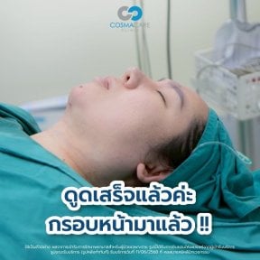 Vaser liposuction result at Cosmacare Clinic Center for Aesthetic Medicine and Plastic Surgery