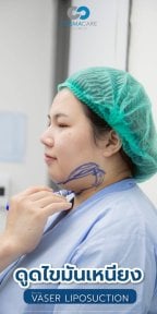 Chin and neck Vaser liposuction preparation at Cosmacare Clinic Center for Aesthetic Medicine