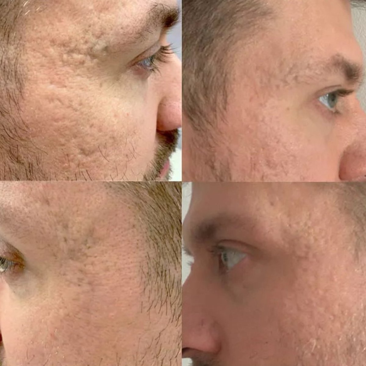 Antes y después de la eliminación de cicatrices con láser en Premier Clinic, mejora de la piel