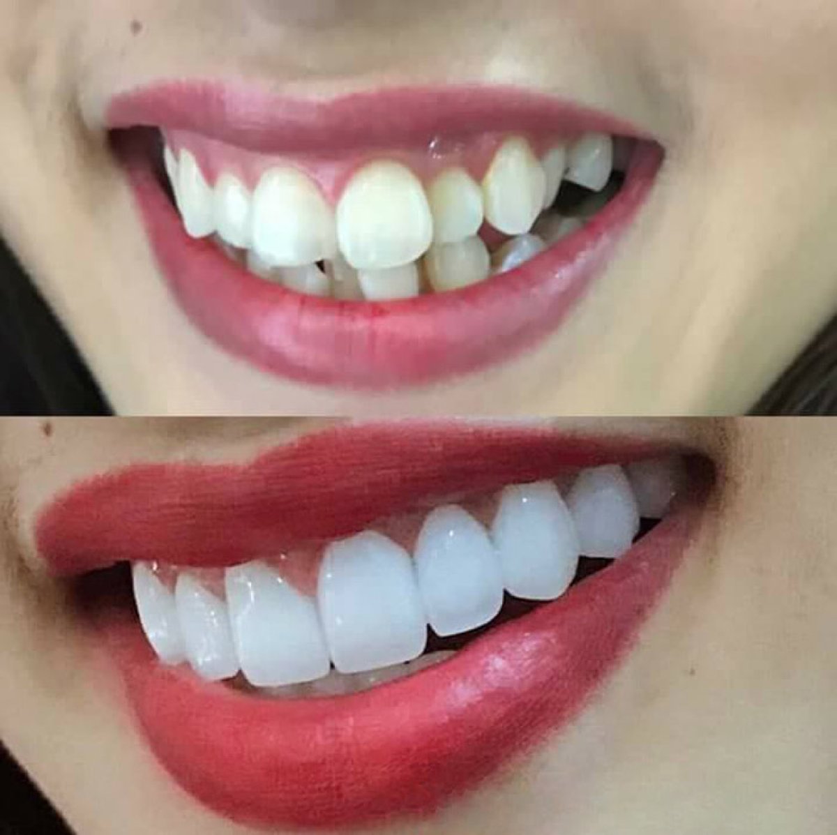 نتائج تبييض الأسنان قبل وبعد في عيادة Dr. Smile Dental Clinic، ابتسامة أكثر إشراقًا