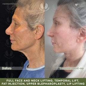 before-after photo deep-plane-facelift