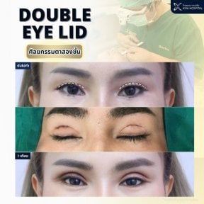 before-after photo blepharoplasty-eyelid