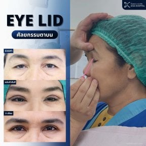 before-after photo blepharoplasty-eyelid