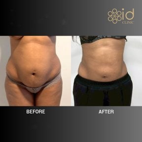 before-after photo vaser-liposuction